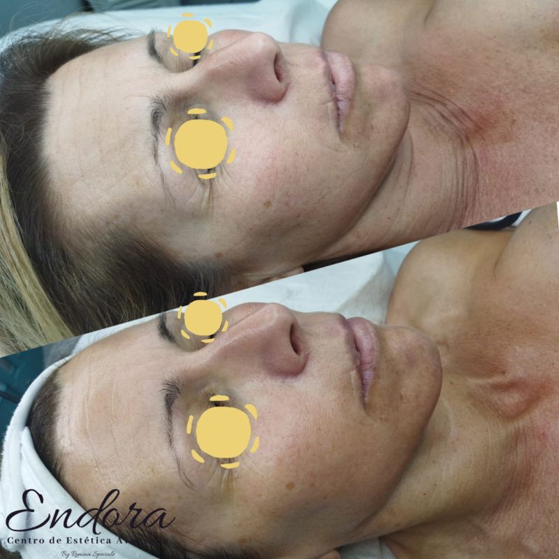 facial con dermapen (3)