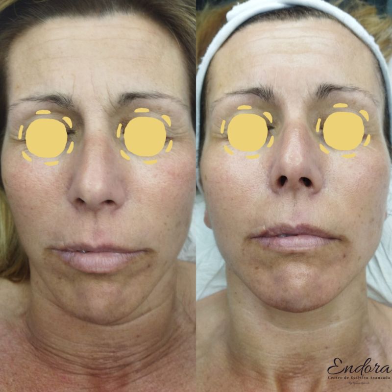facial con dermapen