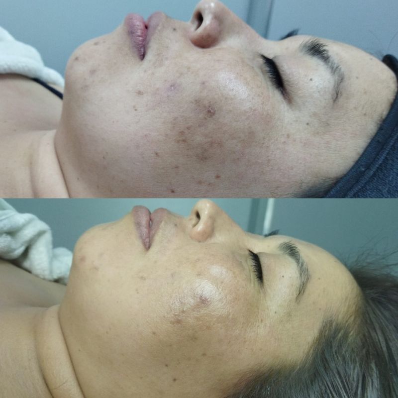facial para manchas (1)