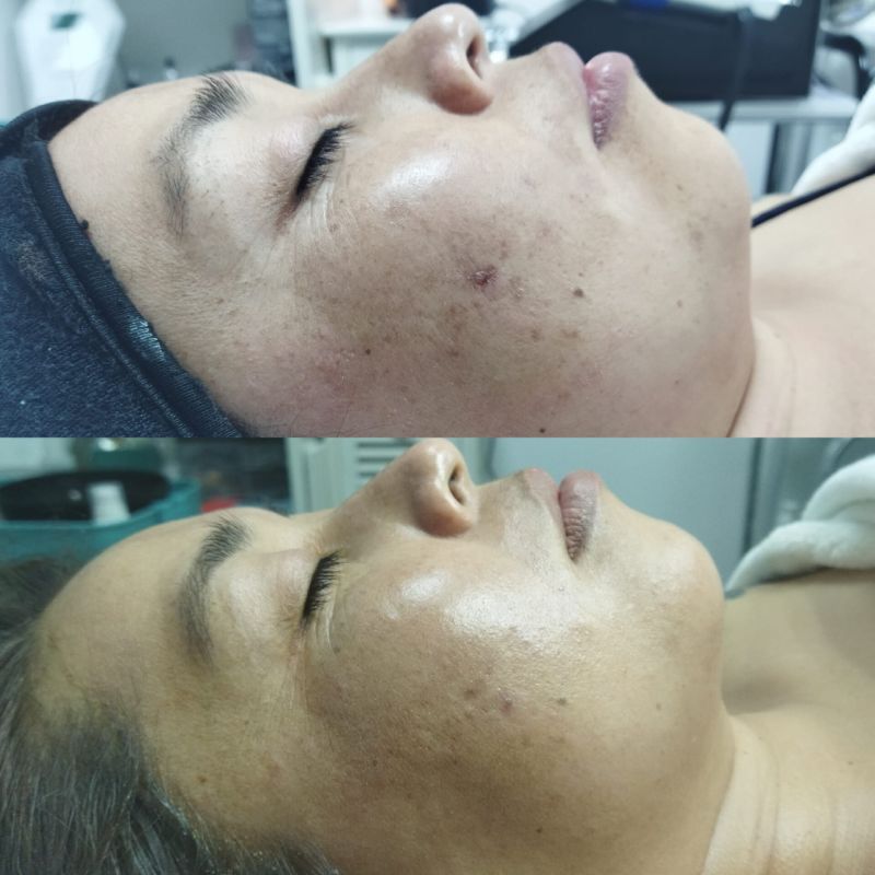 facial para manchas (2)