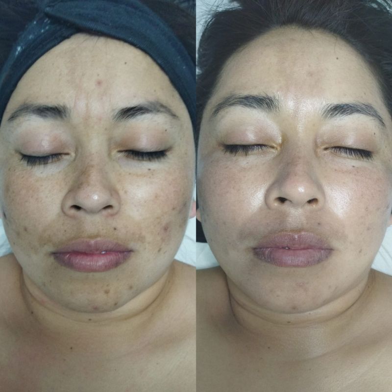 facial para manchas