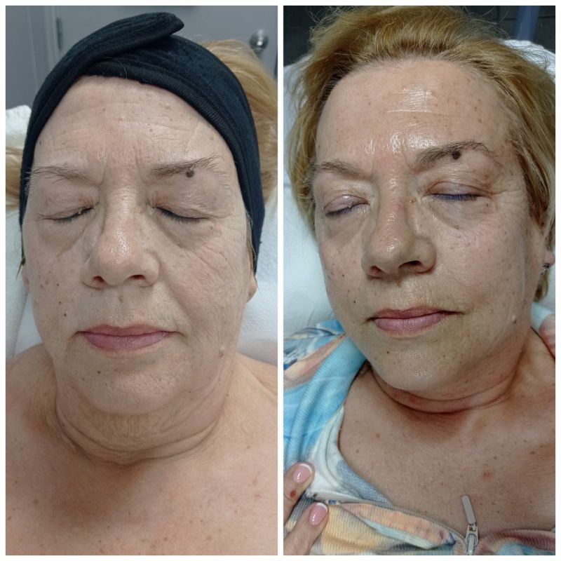 facial personalizado (2)