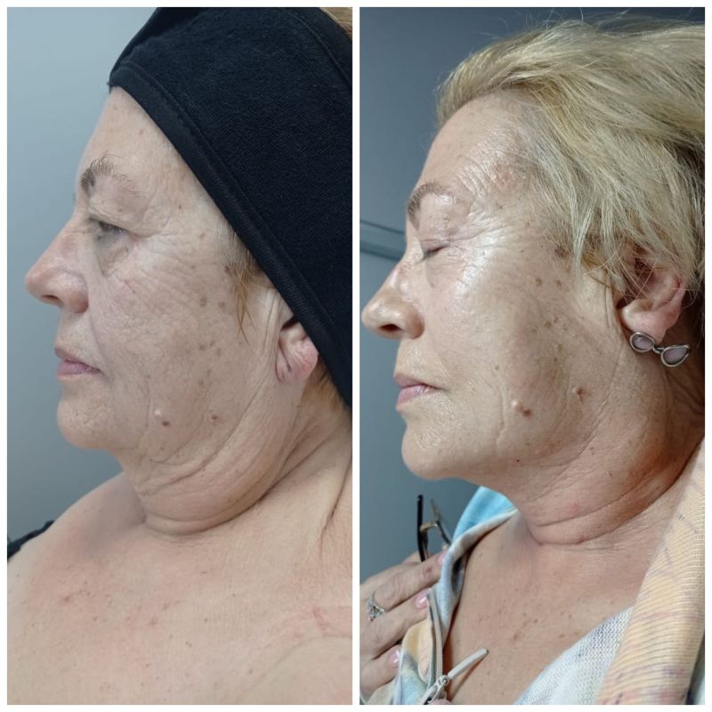 facial personalizado (3)