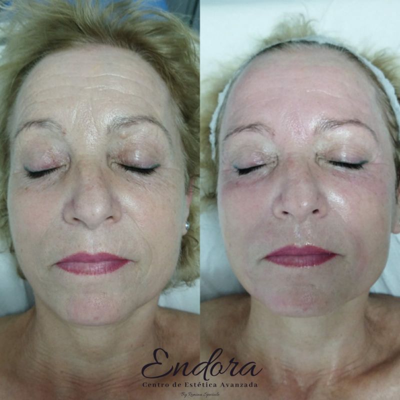 Facial personalizado (1)