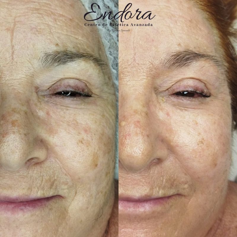 Facial personalizado (4)
