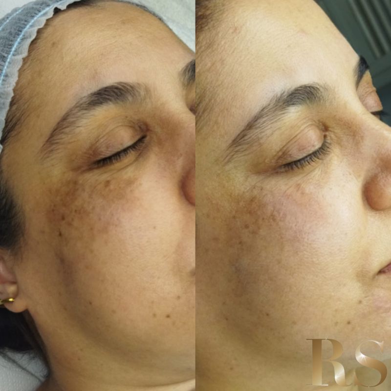 Tratamiento facial para manchas
